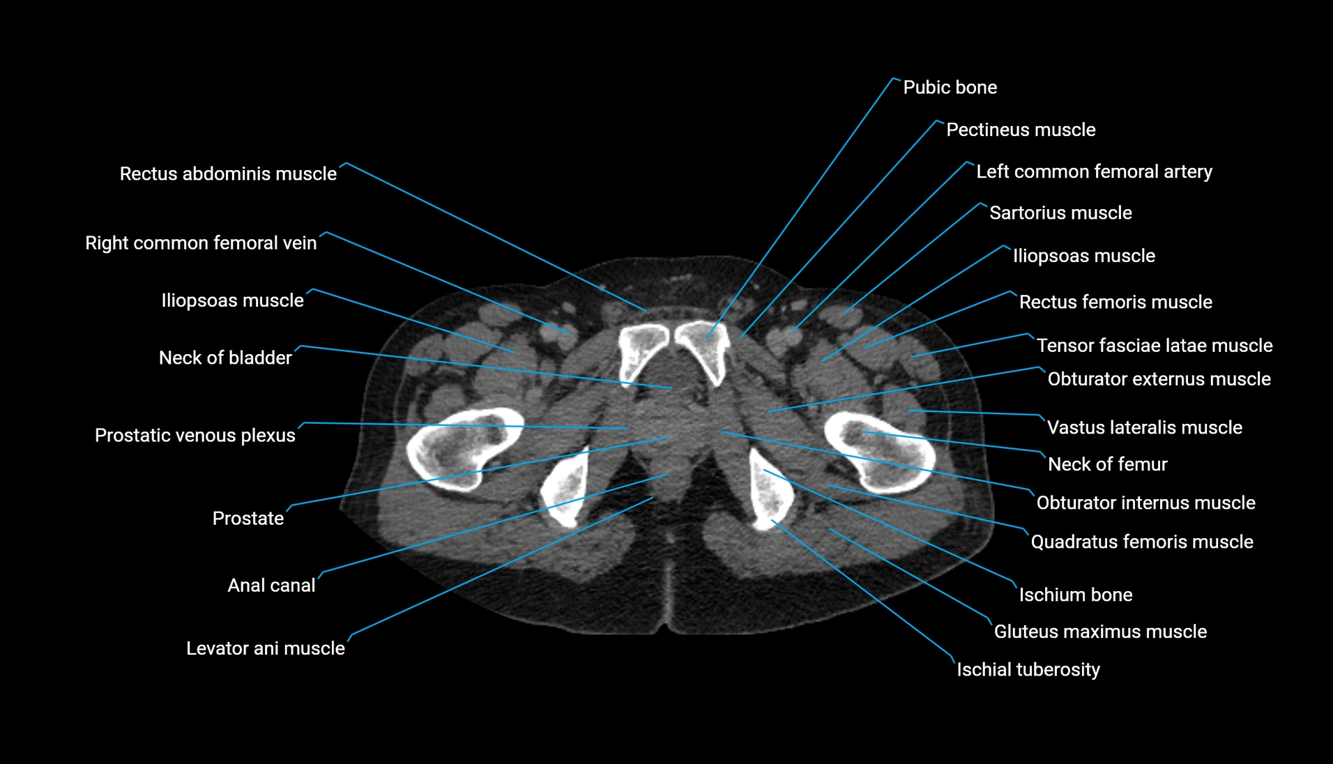 CT urogram axial cross sectional anatomy  labelled radiology image-00251.webp